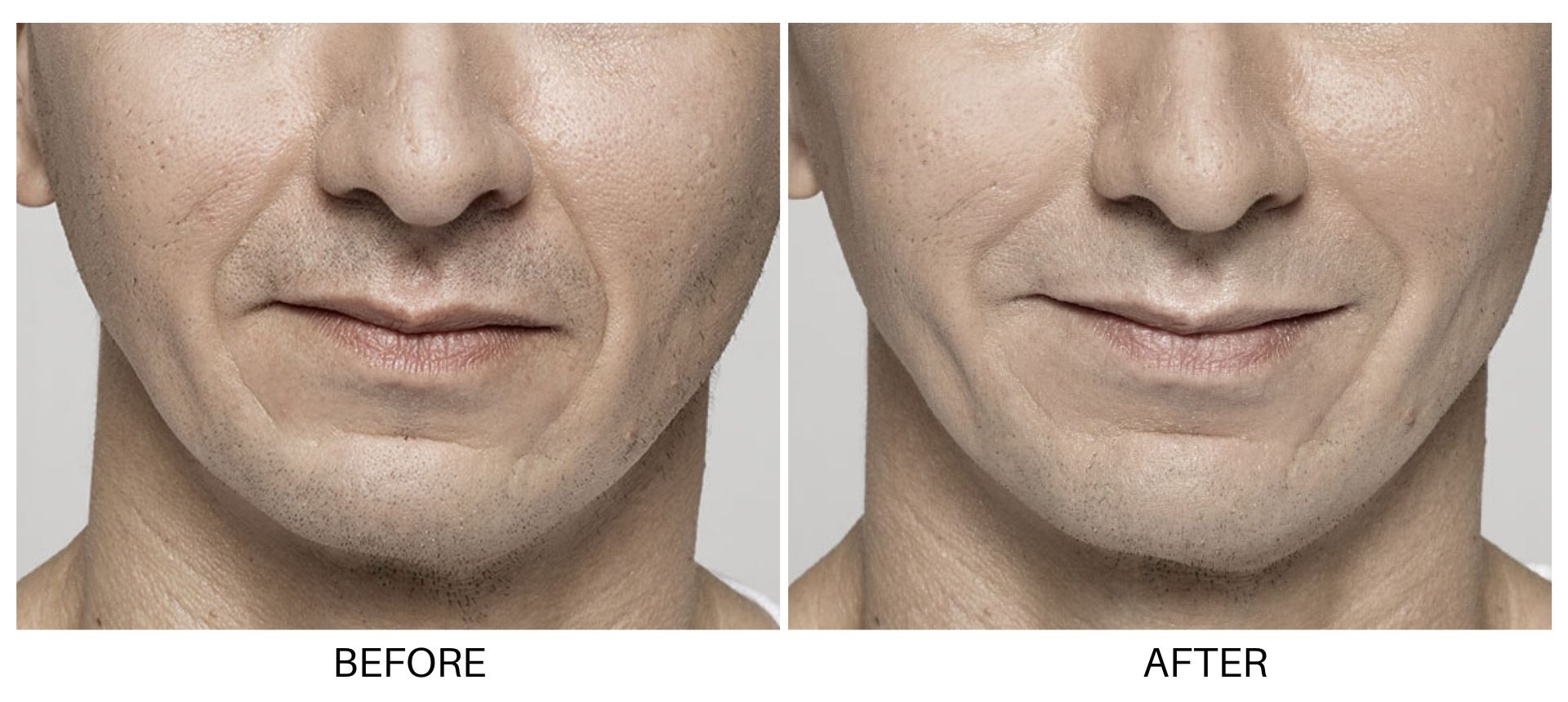 Fight signs of aging now! http://www.freia.sg/fillers 