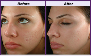 treatment resurfacing 3 skin Ematrix  Grove Resurfacing  Skin In Skin Elm Rejuvenation