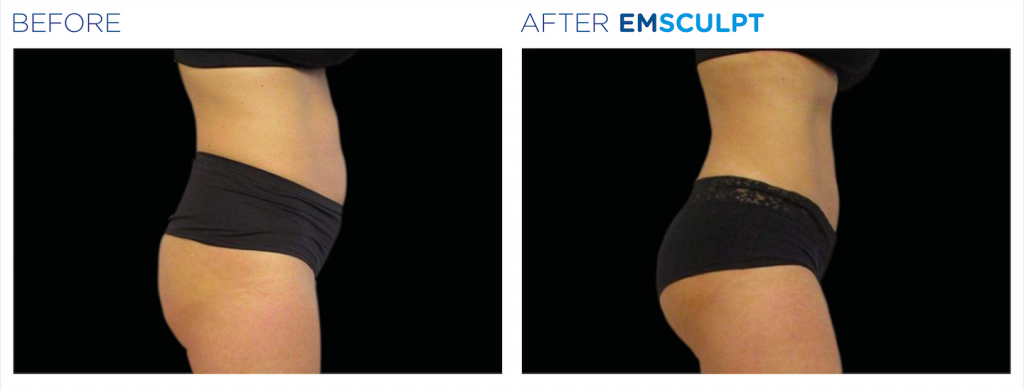 EMSculpt - Buttocks - Forever Young Anti-Aging & Weight Loss Center