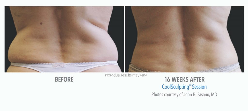 coolsculpting_12-before-and-after-1024x459