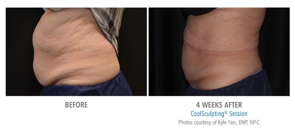 coolsculpting_4-before-and-after-1024x459