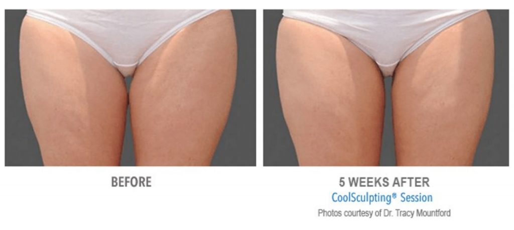 coolsculpting_5-before-and-after-1024x459