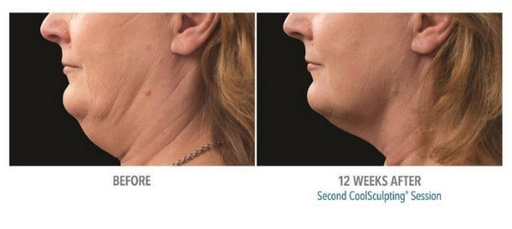 coolsculpting_6-before-and-after-1024x459