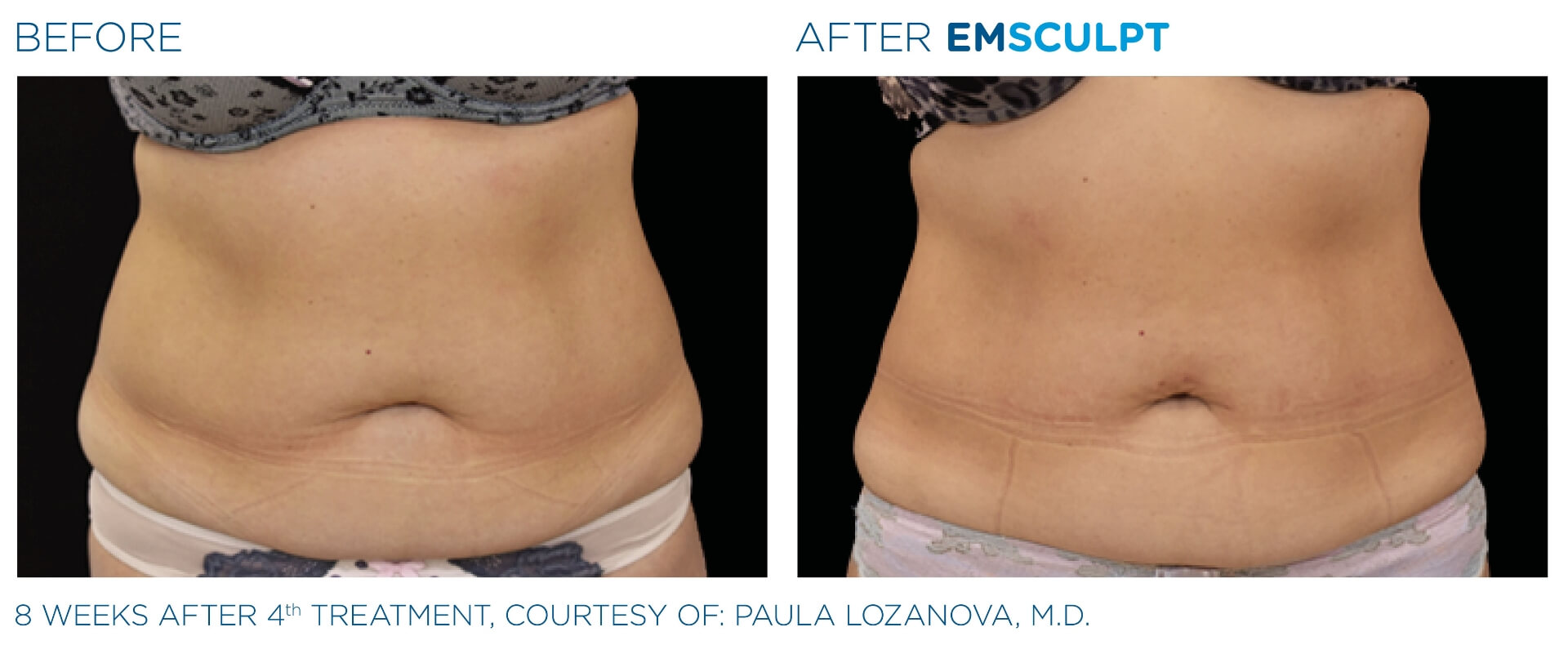 emsculpt_wisconsin_before_and_after_1