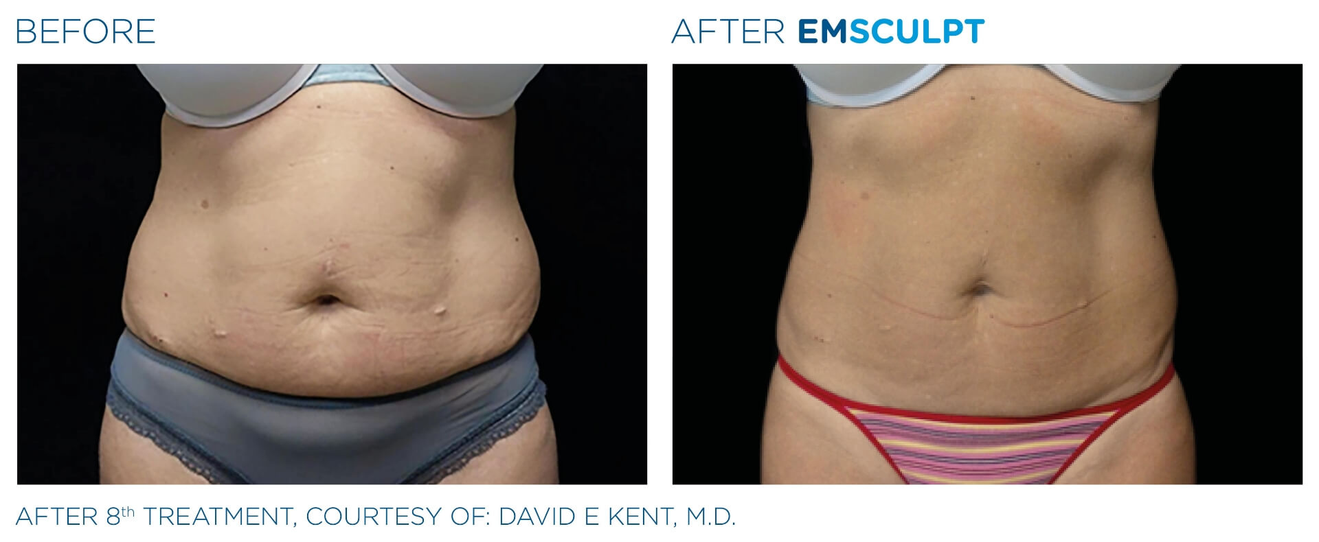 emsculpt_wisconsin_before_and_after_2