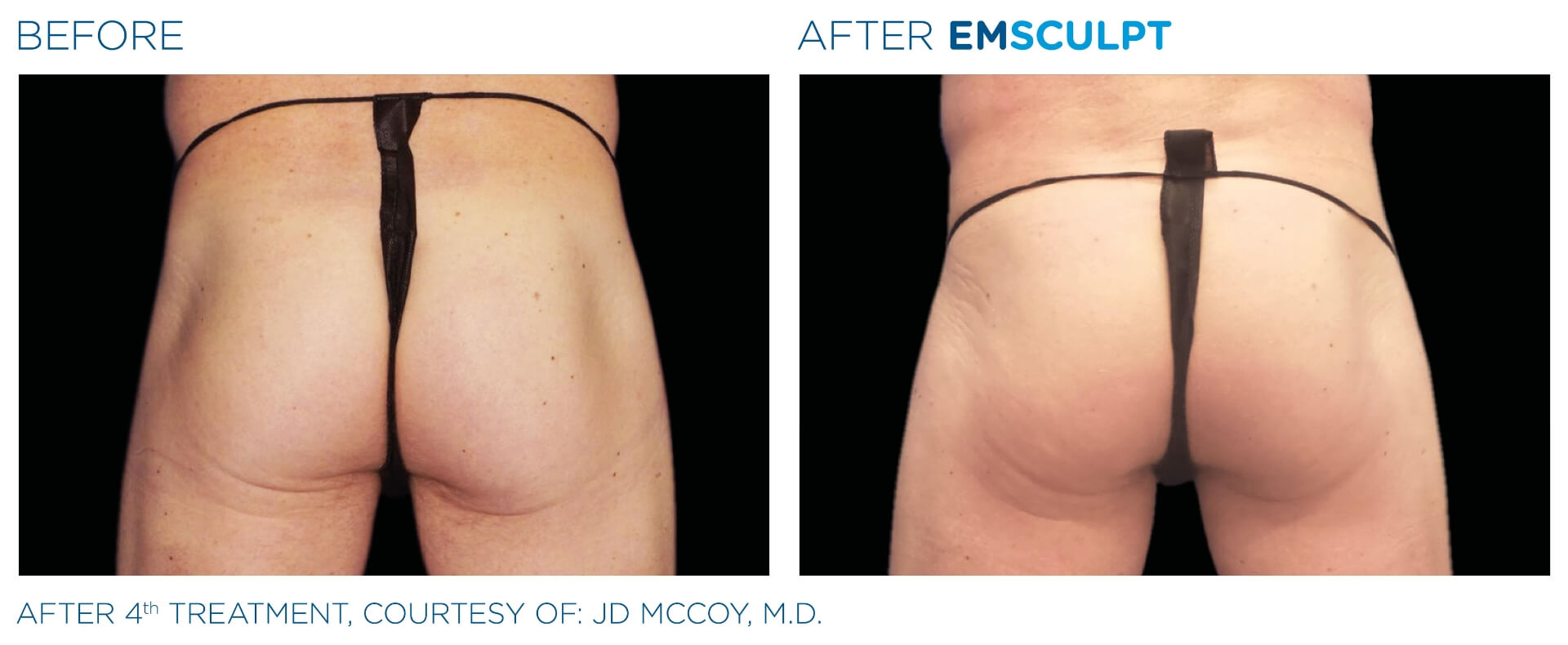 emsculpt_wisconsin_before_and_after_4