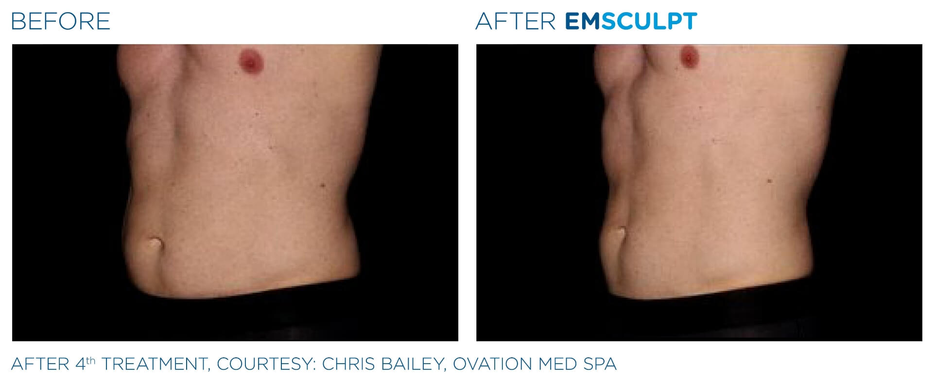 emsculpt_wisconsin_before_and_after_5