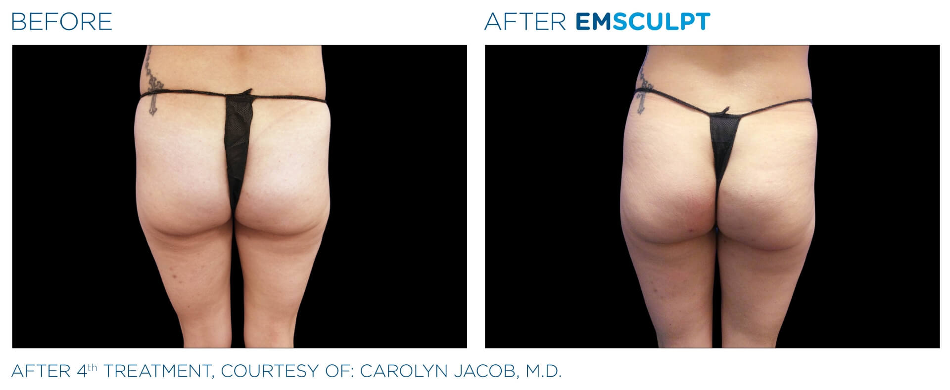 emsculpt_wisconsin_before_and_after_6