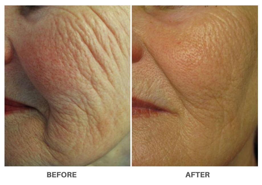 profound_Non_Surgical_Face_Lift_before_after_1