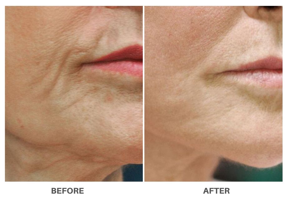 profound_Non_Surgical_Face_Lift_before_after_2