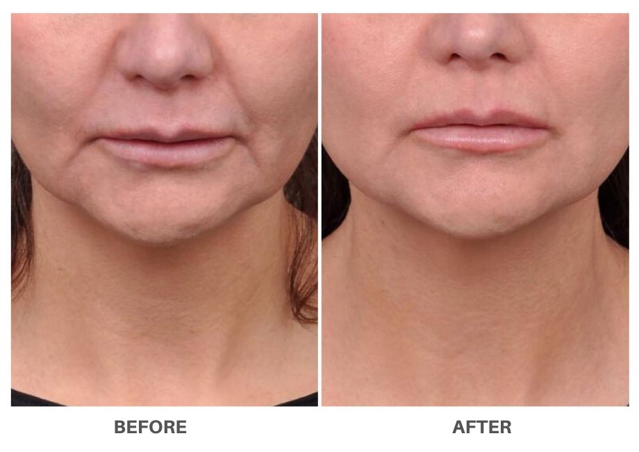 profound_Non_Surgical_Face_Lift_before_after_4