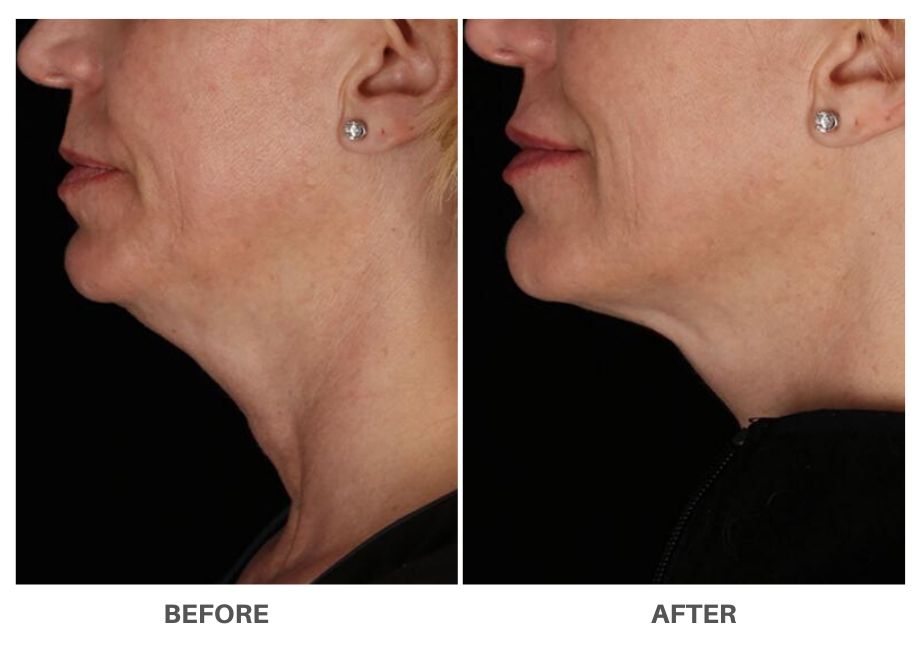 profound_Non_Surgical_Face_Lift_before_after_5