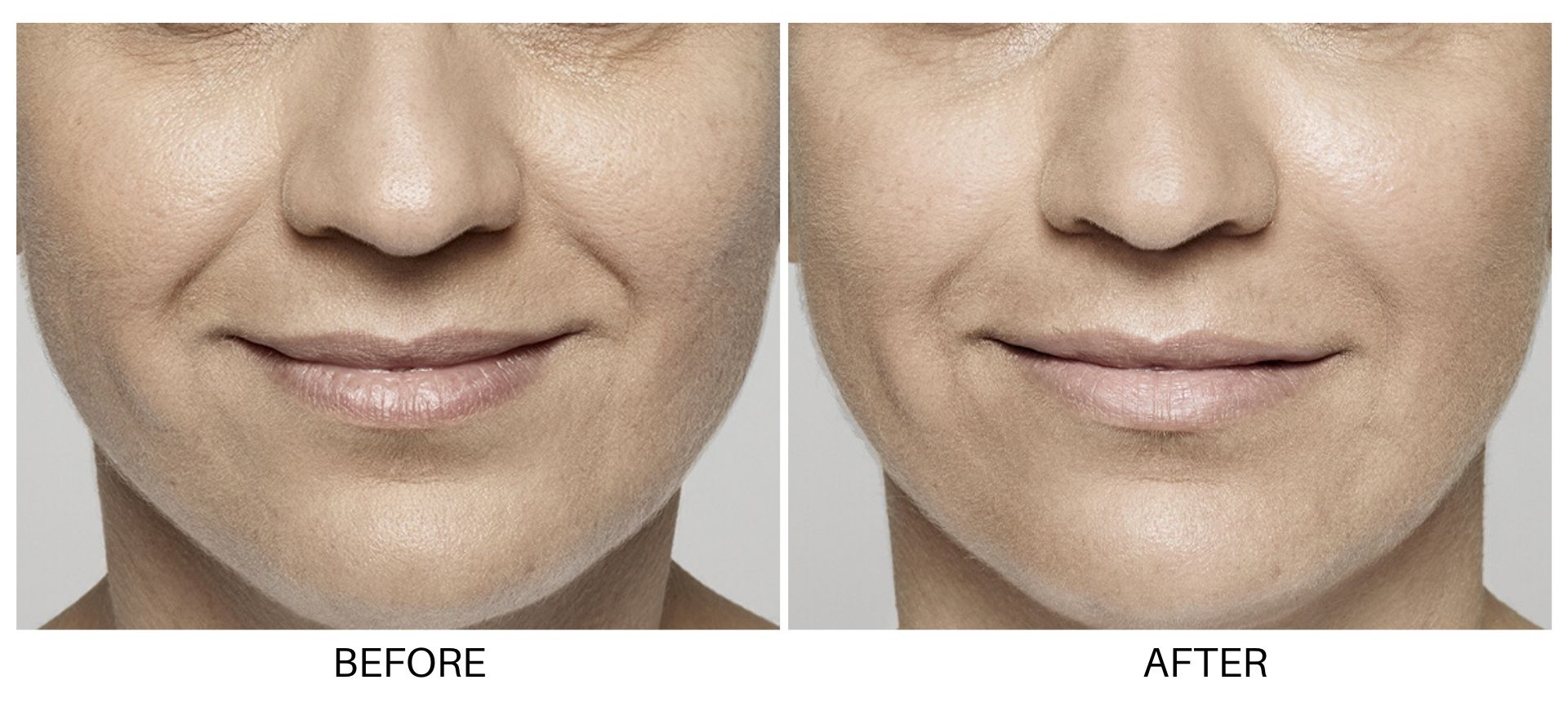 Dermal Fillers In Elm Grove - Fight The Signs Of Aging In 