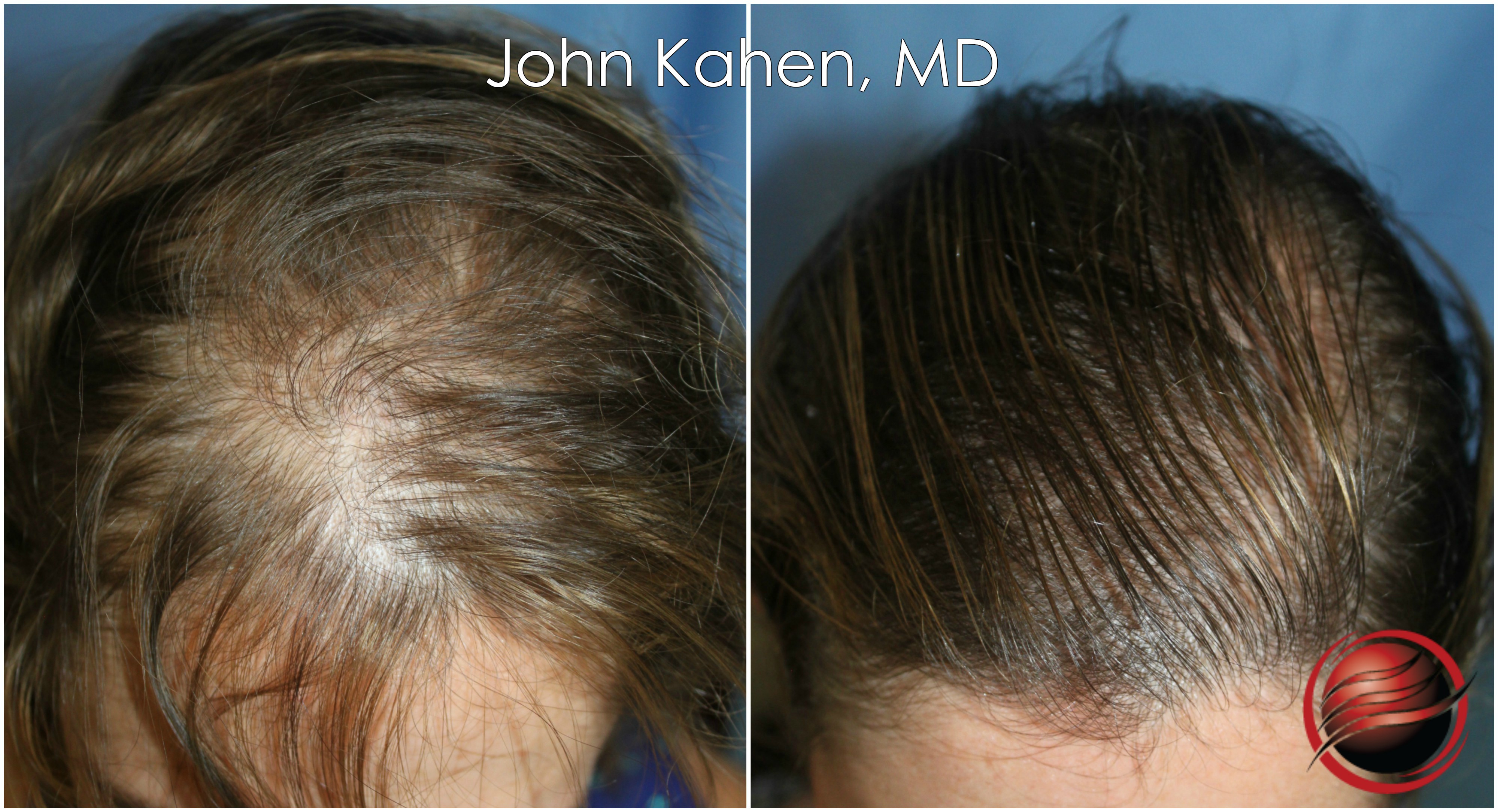 John-Kahen-MD-hair-restoration